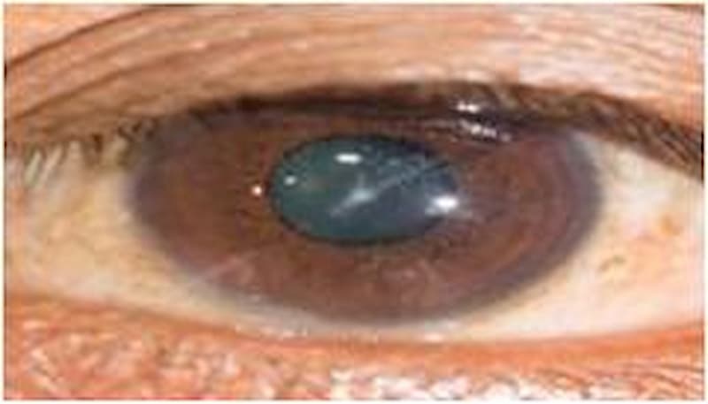 Importante evitar ceguera por retinopatía diabética
