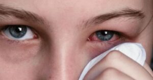 SESEQ emite recomendaciones para evitar la conjuntivitis