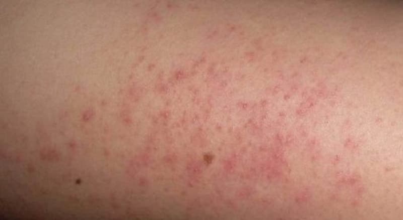 Valoración médica, relevante para cualquier tipo de dermatitis